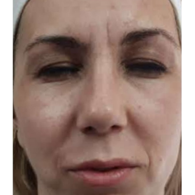 Pre- Biorevitalizacija i dermapen