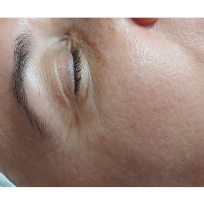 Pre - biorevitalizacija i antiage koktel pre i odmah posle tretmana