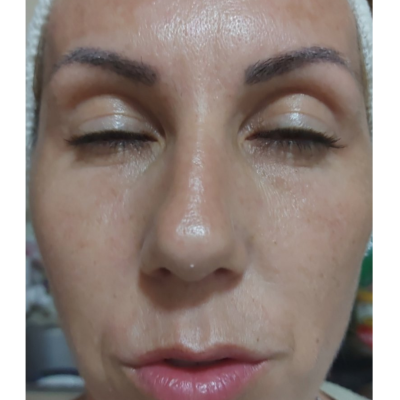 Posle - Biorevitalizacija i dermapen