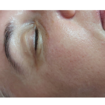 Posle- biorevitalizacija i antiage koktel pre i odmah posle tretmana