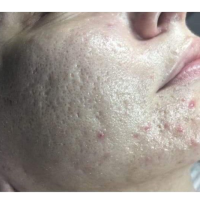 Pre - Dermapen sa Dermclar Gluta koktelom