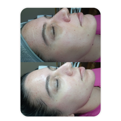 Biorevitalizacija MCCM