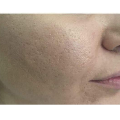 Posle - Dermapen sa Dermclar Gluta koktelom