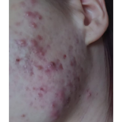 Pre - higijenski tretman sa hemijskim pilingom + biorevitalizacija