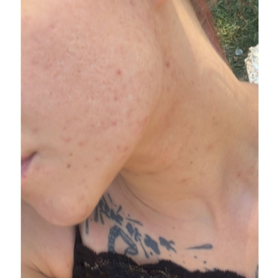 Posle - higijenski tretman sa hemijskim pilingom + biorevitalizacija