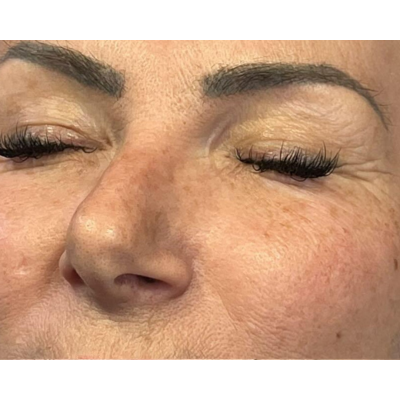 Pre - Red peel 5 MCCM