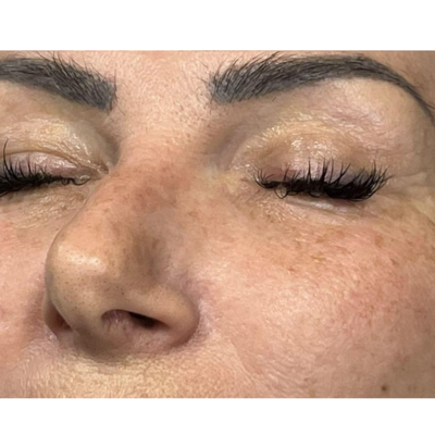 Posle - Red peel 5 MCCM